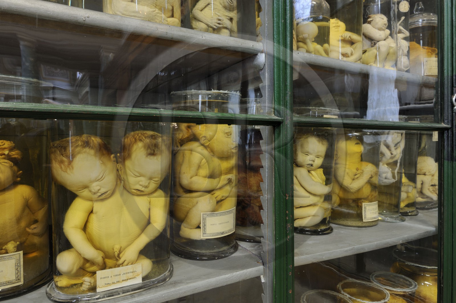 France, Hérault (34), Montpellier, centre historique, faculté de médecine, le musée d'anatomie, foetus de la collection de tératologie qui est l'étude scientifique des malformations congénitales
